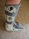 Spent two months wearing this. So much nicer than a plaster cast. I