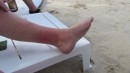 Berits swollen feet and red rash of unknown origin.