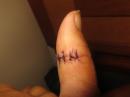 My granulated wound now stitched up: I had a wound for 6 months that wouldn