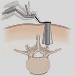 LUMBAR LAMINECTOMY is a spine surgery that involves removing bone to relieve excess pressure on the spinal nerve(s), and may be done using minimally invasive surgery.  A laminectomy removes or "trims" the lamina (roof) of the vertebrae to create space for the nerves leaving the spine.  Traditional, open spine surgery involves cutting or stripping the muscles from the spine.  But today, a lumbar laminectomy may be performed using minimally invasive spine surgery, a treatment that involves small incisions and muscle dilation, allowing the surgeon to gently separate the muscles surrounding the spine rather than cutting them.  To see a really kool animation of the MEDTRONIC METRx System go to http://www.lessinvasivespine.com/metrx-system.html, and to read about the procedure itself go to http://www.lessinvasivespine.com/mis-lumbar-laminectomy.html.  This is really amazing stuff!